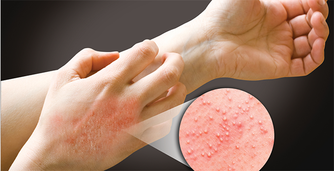 Contact Dermatitis, Chemical and Latex Allergies